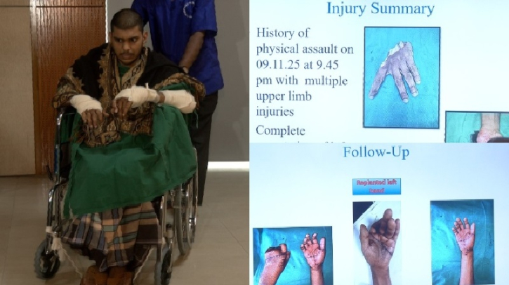 তাসফিনের দুই হাত পুনরায় জোড়া লাগিয়ে দেশে চিকিৎসায় নতুন মাইলফলক